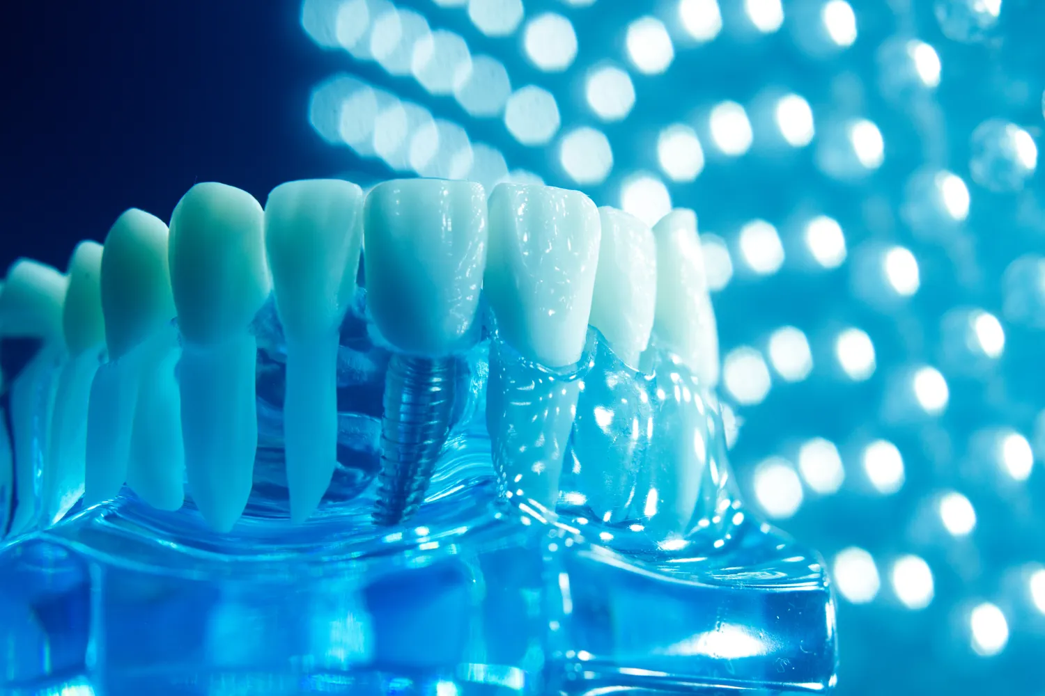 Ile kosztują implanty zębów w Niemczech?