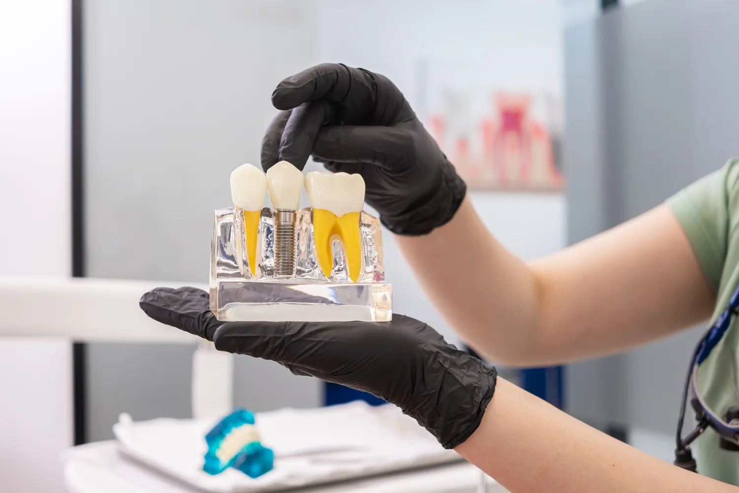 Ile trwa leczenie kanałowe 5?