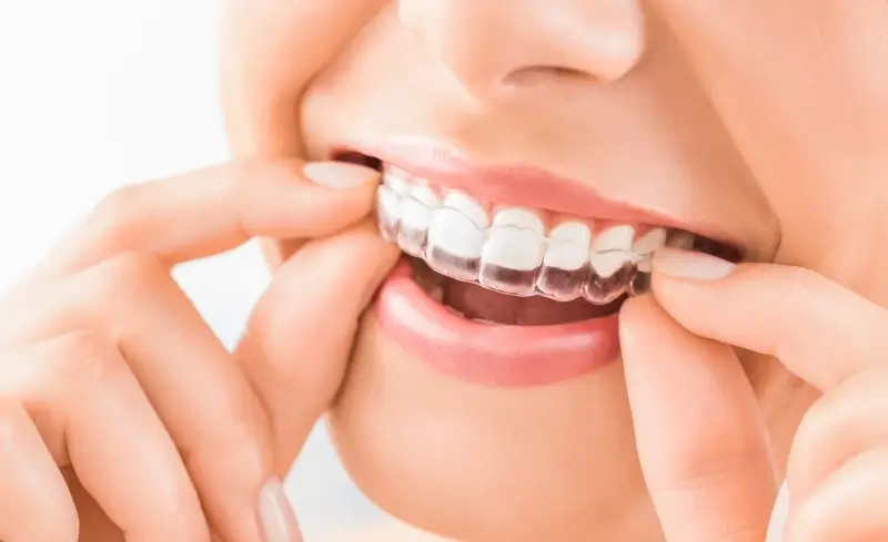 Invisalign czy zwykły aparat?