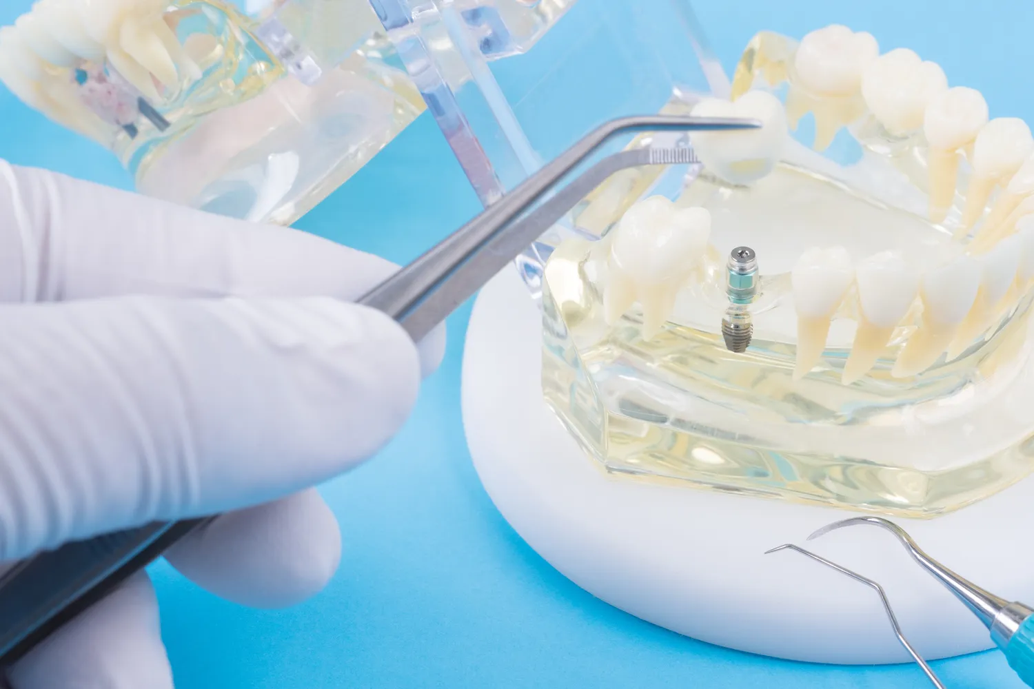 Dentysta Warszawa implanty